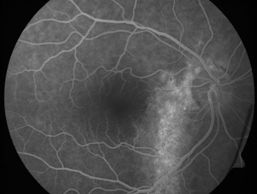 Chronic Central Serous Retinopathy - Gutter in Both Eyes - Treated with PDT - Visudyne
69-year-old man with blurred vision in the right eye for about three weeks.  He had a similar episode about twenty years ago which lasted about six weeks.  He is not taking any steroids.  He takes Lupron injections for his prostate cancer every three months. 

VISUAL ACUITY:  Vision OD is 20/80
FU: Treated with PDT after 6 months of observation with success.  Treatment was done to area between nerve and fovea at 1/2 fluence.
Keywords: csr;visudyne;chronic;gutter;serous