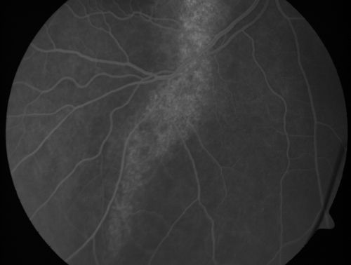 Chronic Central Serous Retinopathy - Gutter in Both Eyes - Treated with PDT - Visudyne
69-year-old man with blurred vision in the right eye for about three weeks.  He had a similar episode about twenty years ago which lasted about six weeks.  He is not taking any steroids.  He takes Lupron injections for his prostate cancer every three months. 

VISUAL ACUITY:  Vision OD is 20/80
FU: Treated with PDT after 6 months of observation with success.  Treatment was done to area between nerve and fovea at 1/2 fluence.
Keywords: csr;visudyne;chronic;gutter;serous