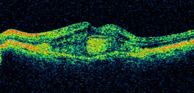 Subfoveal CNVM wet AMD oct line scan
She has noticed decreased vision in the left eye.  It is hard to say for how long, maybe a few months.  She had her last eye exam about a year ago.  She thoughts perhaps it was cataracts, but you saw a problem with the macula and suggested she come here for evaluation.

VISUAL ACUITY: Vision OD is 20/25, OS is 2/200
Keywords: wet amd; macular degeneration; classic; subfoveal cnvm;