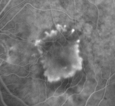 Subfoveal CNVM wet AMD early fa (contrast enhanced with photoshop)
She has noticed decreased vision in the left eye.  It is hard to say for how long, maybe a few months.  She had her last eye exam about a year ago.  She thoughts perhaps it was cataracts, but you saw a problem with the macula and suggested she come here for evaluation.

VISUAL ACUITY: Vision OD is 20/25, OS is 2/200
Keywords: wet amd; macular degeneration; classic; subfoveal cnvm;