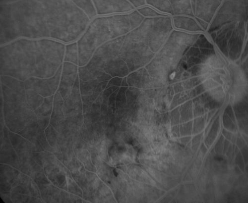 Myopic CNVM - Wet - rx Avastin for 1 year
55-year-old woman  OD is 20/40, OS is 20/20.  There is a hyperpigmented disc diameter choroidal neovascular membrane with fluid touching the fovea. 
Schlüsselwörter: myopic;wet;macular degeneration;cnvm;avastin