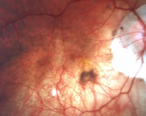Myopic CNVM - Wet - rx Avastin for 1 year
55-year-old woman  OD is 20/40, OS is 20/20.  There is a hyperpigmented disc diameter choroidal neovascular membrane with fluid touching the fovea.
Keywords: myopic;wet;macular degeneration;cnvm;avastin