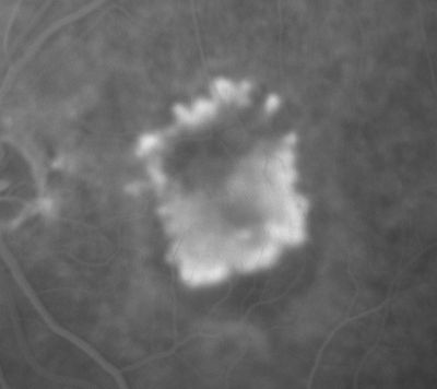 Subfoveal CNVM wet AMD late fa
85-year-old woman was seen in the office on 11/8/07.  She has noticed decreased vision in the left eye.  It is hard to say for how long, maybe a few months.  She had her last eye exam about a year ago.  She thoughts perhaps it was cataracts, but you saw a problem with the macula and suggested she come here for evaluation.

VISUAL ACUITY: Vision OD is 20/25, OS is 2/200
Keywords: wet amd; macular degeneration; classic; subfoveal cnvm;