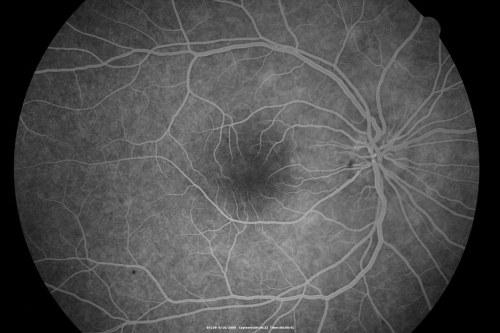 Multiple Evanescent White Dot Syndrome - Atypical Yellow Foveal Spot Right Eye
12-year-old had decreased vision in the left eye from reported amblyopia since around the year 2000.  His right eye was doing fine until  two days ago, when he had sudden severe vision loss.  He sees a blurred spot in the middle of the vision in the right eye wherever he looks. 
 OD 20/60 with eccentric movement, OS 20/200.   Pinhole 20/70.  IOP:  OD 14, OS 10.
Keywords: mewds;multiple evanescent white dot syndrome;yellow spot