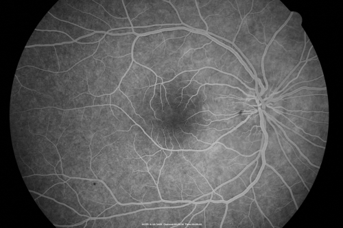 Multiple Evanescent White Dot Syndrome - Atypical Yellow Foveal Spot Right Eye
12-year-old had decreased vision in the left eye from reported amblyopia since around the year 2000.  His right eye was doing fine until  two days ago, when he had sudden severe vision loss.  He sees a blurred spot in the middle of the vision in the right eye wherever he looks. 
 OD 20/60 with eccentric movement, OS 20/200.   Pinhole 20/70.  IOP:  OD 14, OS 10.
Keywords: mewds;multiple evanescent white dot syndrome;yellow spot