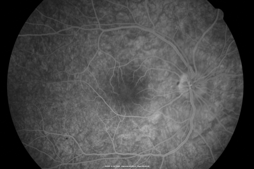Multiple Evanescent White Dot Syndrome - Atypical Yellow Foveal Spot Right Eye
12-year-old had decreased vision in the left eye from reported amblyopia since around the year 2000.  His right eye was doing fine until  two days ago, when he had sudden severe vision loss.  He sees a blurred spot in the middle of the vision in the right eye wherever he looks. 
 OD 20/60 with eccentric movement, OS 20/200.   Pinhole 20/70.  IOP:  OD 14, OS 10.
Keywords: mewds;multiple evanescent white dot syndrome;yellow spot