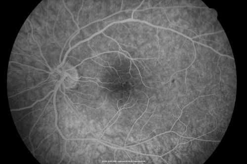 Multiple Evanescent White Dot Syndrome - Atypical Yellow Foveal Spot Right Eye
12-year-old had decreased vision in the left eye from reported amblyopia since around the year 2000.  His right eye was doing fine until  two days ago, when he had sudden severe vision loss.  He sees a blurred spot in the middle of the vision in the right eye wherever he looks. 
 OD 20/60 with eccentric movement, OS 20/200.   Pinhole 20/70.  IOP:  OD 14, OS 10.
Keywords: mewds;multiple evanescent white dot syndrome;yellow spot