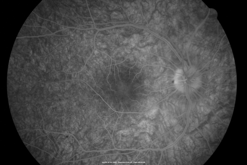 Multiple Evanescent White Dot Syndrome - Atypical Yellow Foveal Spot Right Eye
12-year-old had decreased vision in the left eye from reported amblyopia since around the year 2000.  His right eye was doing fine until  two days ago, when he had sudden severe vision loss.  He sees a blurred spot in the middle of the vision in the right eye wherever he looks. 
 OD 20/60 with eccentric movement, OS 20/200.   Pinhole 20/70.  IOP:  OD 14, OS 10.
Keywords: mewds;multiple evanescent white dot syndrome;yellow spot