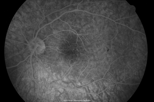 Multiple Evanescent White Dot Syndrome - Atypical Yellow Foveal Spot Right Eye
12-year-old had decreased vision in the left eye from reported amblyopia since around the year 2000.  His right eye was doing fine until  two days ago, when he had sudden severe vision loss.  He sees a blurred spot in the middle of the vision in the right eye wherever he looks. 
 OD 20/60 with eccentric movement, OS 20/200.   Pinhole 20/70.  IOP:  OD 14, OS 10.
Schlüsselwörter: mewds;multiple evanescent white dot syndrome;yellow spot