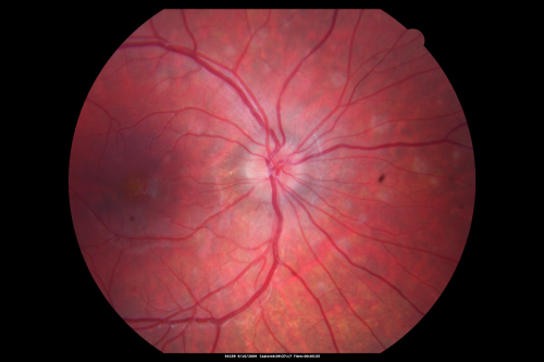 Multiple Evanescent White Dot Syndrome - Atypical Yellow Foveal Spot Right Eye
12-year-old had decreased vision in the left eye from reported amblyopia since around the year 2000.  His right eye was doing fine until  two days ago, when he had sudden severe vision loss.  He sees a blurred spot in the middle of the vision in the right eye wherever he looks. 
 OD 20/60 with eccentric movement, OS 20/200.   Pinhole 20/70.  IOP:  OD 14, OS 10.
Keywords: mewds;multiple evanescent white dot syndrome;yellow spot