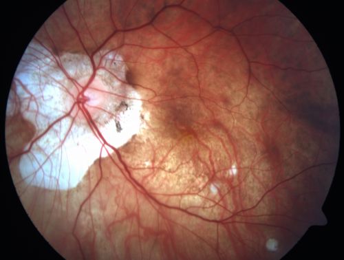 Myopic CNVM - Wet - rx Avastin for 1 year
55-year-old woman  OD is 20/40, OS is 20/20.  There is a hyperpigmented disc diameter choroidal neovascular membrane with fluid touching the fovea.
Võtmesõnad: myopic;wet;macular degeneration;cnvm;avastin