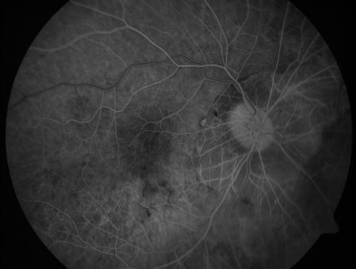 Myopic CNVM - Wet - rx Avastin for 1 year
55-year-old woman  OD is 20/40, OS is 20/20.  There is a hyperpigmented disc diameter choroidal neovascular membrane with fluid touching the fovea. 
Keywords: myopic;wet;macular degeneration;cnvm;avastin