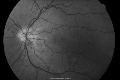 PDR OS with NVE
57-year-old man has diabetic retinopathy in both eyes. 
Diabetic for 14 years with HgB A1C often over 10. 
VISUAL ACUITY:  OD 20/30,  OS 20/40. PDR OS BDR OD
