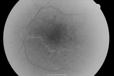 PDR OS with NVE
57-year-old man has diabetic retinopathy in both eyes. 
Diabetic for 14 years with HgB A1C often over 10. 
VISUAL ACUITY:  OD 20/30,  OS 20/40. PDR OS BDR OD
