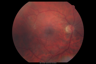 Macular Pucker in eye following giant retinal tear RD repair post-op Fundus Photo
now that the bubble is gone, but he is starting to notice distortion of central vision.  He had a giant retinal tear retinal detachment repair emergently done on November 8, 2007, and subsequent laser on November 15th.  
 
VISUAL ACUITY:  Vision OD 20/400.  

6 weeks post-op VA 20/40
Schlüsselwörter: macular pucker; post-retinal detachment; giant retinal tear