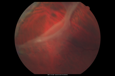 Macular Pucker in eye following giant retinal tear RD repair - photo of tear
 42-year old man has noticed his vision is changing now that the bubble is gone, but he is starting to notice distortion of central vision.  He had a giant retinal tear retinal detachment repair emergently done on November 8, 2007, and subsequent laser on November 15th.  
 
VISUAL ACUITY:  Vision OD 20/400.  

6 weeks post-op VA 20/40
Keywords: macular pucker; post-retinal detachment; giant retinal tear