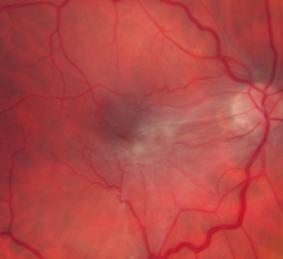 Macular Pucker in eye following giant retinal tear RD repair pre-op Macular Photo Pucker
now that the bubble is gone, but he is starting to notice distortion of central vision.  He had a giant retinal tear retinal detachment repair emergently done on November 8, 2007, and subsequent laser on November 15th.  
 
VISUAL ACUITY:  Vision OD 20/400.  

6 weeks post-op VA 20/40
Keywords: macular pucker; post-retinal detachment; giant retinal tear