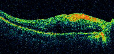 Macular Pucker in eye following giant retinal tear RD repair pre-op OCT
now that the bubble is gone, but he is starting to notice distortion of central vision.  He had a giant retinal tear retinal detachment repair emergently done on November 8, 2007, and subsequent laser on November 15th.  
 
VISUAL ACUITY:  Vision OD 20/400.  

6 weeks post-op VA 20/40
Keywords: macular pucker; post-retinal detachment; giant retinal tear