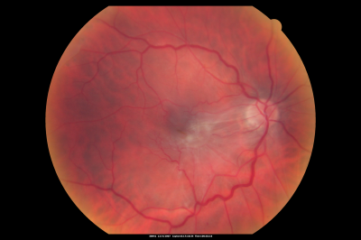 Macular Pucker in eye following giant retinal tear RD repair pre-op pucker photo
now that the bubble is gone, but he is starting to notice distortion of central vision.  He had a giant retinal tear retinal detachment repair emergently done on November 8, 2007, and subsequent laser on November 15th.  
 
VISUAL ACUITY:  Vision OD 20/400.  

6 weeks post-op VA 20/40
Mots-clés: macular pucker; post-retinal detachment; giant retinal tear