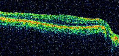 Macular Pucker
.  This pleasant 59-year-old man had vitrectomy for a macular pucker in the right eye in July.  His vision is gradually improving.   

VISUAL ACUITY:  Vision OD is 20/30.  IOP:  OD 22.  There is 2+ nuclear sclerosis.

EXTENDED OPHTHALMOSCOPY:
OD:  Vertical C/D ratio is 0.5.  The macula is smooth and the retina is attached.

OCT SCAN:  The OCT scan shows an average central foveal thickness of 349 microns, which compares favorably to the pre-op thickness of 482 microns.

Keywords: Macular Pucker