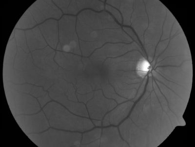 Macular Pucker
.  This pleasant 59-year-old man had vitrectomy for a macular pucker in the right eye in July.  His vision is gradually improving.   

VISUAL ACUITY:  Vision OD is 20/30.  IOP:  OD 22.  There is 2+ nuclear sclerosis.

EXTENDED OPHTHALMOSCOPY:
OD:  Vertical C/D ratio is 0.5.  The macula is smooth and the retina is attached.

OCT SCAN:  The OCT scan shows an average central foveal thickness of 349 microns, which compares favorably to the pre-op thickness of 482 microns.


Schlüsselwörter: Macular Pucker