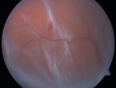 Retinal Detachment
Keywords: Retinal Detachment