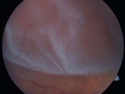 Retinal Detachment
Võtmesõnad: Retinal Detachment