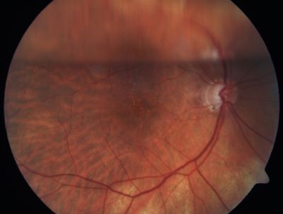 Retinal Detachment
Schlüsselwörter: Retinal Detachment
