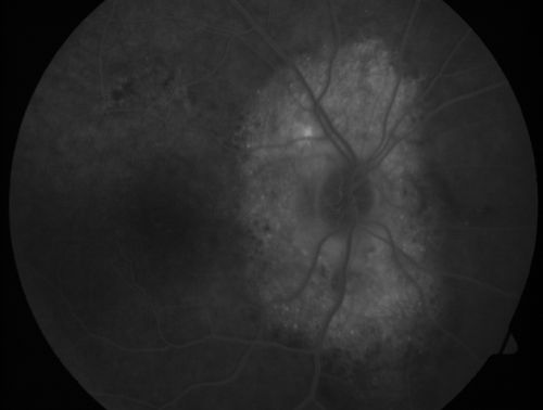 Peripapillary Lesion Hemangioma or CNVM Late FA Shows Hyperfluorescent Lesion
67-year-old man with a history of a peripapillary lesion in the right eye.  
Keywords: peripapillary;hemangioma;unknown