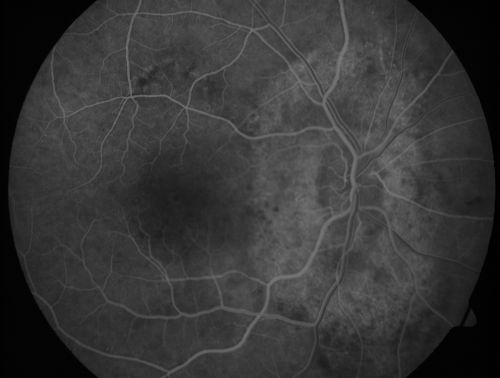 Peripapillary Lesion Hemangioma or CNVM Early FA
67-year-old man with a history of a peripapillary lesion in the right eye. 
Keywords: peripapillary;hemangioma;unknown