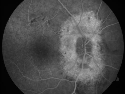 Peripapillary Lesion Hemangioma or CNVM Midphase FA
67-year-old man with a history of a peripapillary lesion in the right eye.  
Keywords: peripapillary;hemangioma;unknown