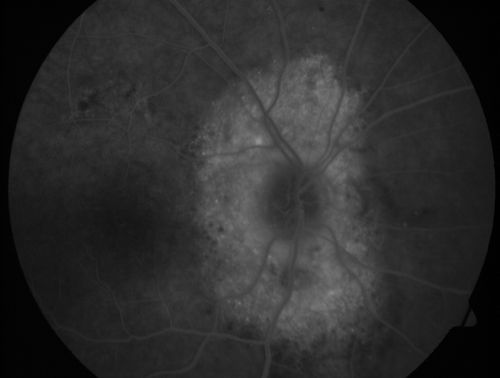 Peripapillary Lesion Hemangioma or CNVM LATE FA
67-year-old man with a history of a peripapillary lesion in the right eye.  VA 20/400.  Worsening vision.  
Keywords: peripapillary;hemangioma;unknown