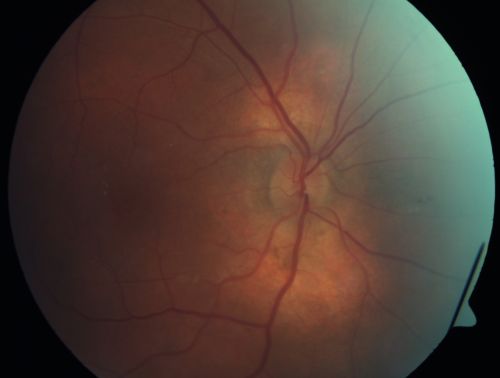 Peripapillary Lesion Hemangioma or CNVM Fundus Photo Right Eye Shows Peripapillary Lesion
67-year-old man with a history of a peripapillary lesion in the right eye.  
Keywords: peripapillary;hemangioma;unknown
