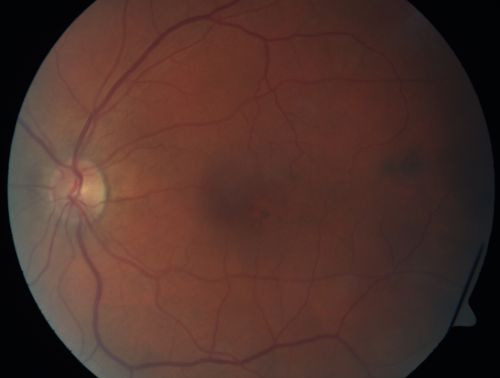 Peripapillary Lesion Hemangioma or CNVM Color Fundus Photo Normal Left Eye
67-year-old man with a history of a peripapillary lesion in the right eye.  
Keywords: peripapillary;hemangioma;unknown