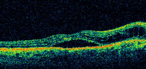 Peripapillary Lesion Hemangioma or CNVM Line Scan Shows Serous RD Right Eye
67-year-old man with a history of a peripapillary lesion in the right eye.  
Keywords: peripapillary;hemangioma;unknown