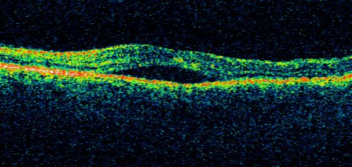 Peripapillary Lesion Hemangioma or CNVM Line Scan shows Serous RD OD
67-year-old man with a history of a peripapillary lesion in the right eye.  
Keywords: peripapillary;hemangioma;unknown