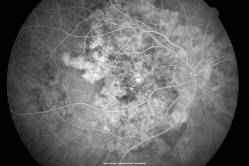 Polypoidal Choroidal Vasculopathy Right Eye - Disciform Scar Left Eye
84-year-old woman has polypoidal choroidal vasculopathy in both eyes with macular degeneration.  She has macular scars in both eyes and she remains with remarkably good vision in the right eye despite the scarring.  

VISUAL ACUITY:  OD 20/30,  OS 1/200

Avastin Rx OD
