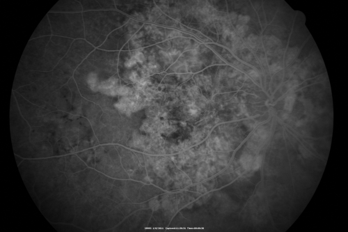 Polypoidal Choroidal Vasculopathy Right Eye - Disciform Scar Left Eye
84-year-old woman has polypoidal choroidal vasculopathy in both eyes with macular degeneration.  She has macular scars in both eyes and she remains with remarkably good vision in the right eye despite the scarring.  

VISUAL ACUITY:  OD 20/30,  OS 1/200

Avastin Rx OD
