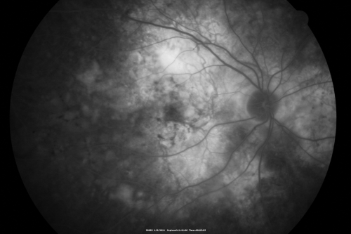 Polypoidal Choroidal Vasculopathy Right Eye - Disciform Scar Left Eye
84-year-old woman has polypoidal choroidal vasculopathy in both eyes with macular degeneration.  She has macular scars in both eyes and she remains with remarkably good vision in the right eye despite the scarring.  

VISUAL ACUITY:  OD 20/30,  OS 1/200

Avastin Rx OD
