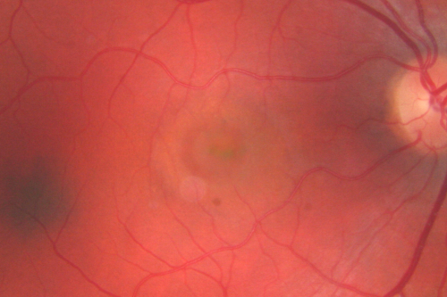 Central Serous Retinopathy 41 year old woman with Vision Loss for One Year
41-year-old woman has chronic central serous retinopathy in the right eye with decreased vision in that eye for over a year.  Her vision has been waxing and waning and recently is getting worse.  Her vision in the left eye is fine.  

VISUAL ACUITY:  OD 20/40
