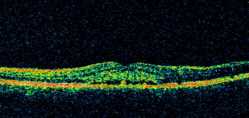 Central Serous Retinopathy 41 year old woman with Vision Loss for One Year
41-year-old woman has chronic central serous retinopathy in the right eye with decreased vision in that eye for over a year.  Her vision has been waxing and waning and recently is getting worse.  Her vision in the left eye is fine.  

VISUAL ACUITY:  OD 20/40

