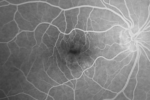 Central Serous Retinopathy 41 year old woman with Vision Loss for One Year
41-year-old woman has chronic central serous retinopathy in the right eye with decreased vision in that eye for over a year.  Her vision has been waxing and waning and recently is getting worse.  Her vision in the left eye is fine.  

VISUAL ACUITY:  OD 20/40
