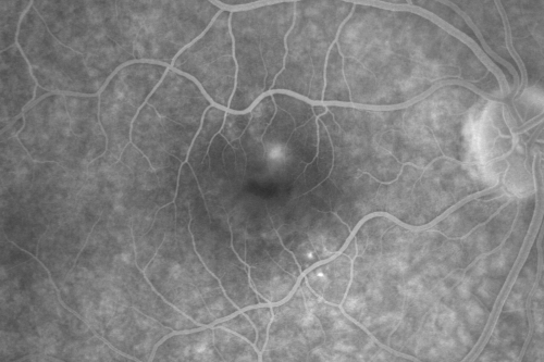 Central Serous Retinopathy 41 year old woman with Vision Loss for One Year
41-year-old woman has chronic central serous retinopathy in the right eye with decreased vision in that eye for over a year.  Her vision has been waxing and waning and recently is getting worse.  Her vision in the left eye is fine.  

VISUAL ACUITY:  OD 20/40
