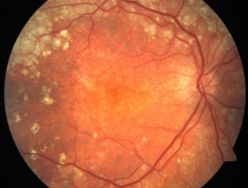 Basal Laminar Drusen - Cuticular Drusen - Equatorial Drusen - 70 Year Old Woman - Macular Photo Right Eye
70 year old woman has had macular drusen since her thirties and she said her sister has a similar problem.  Recently the vision in the left eye has substantially declined. OD 20/16, OS 10/200.
