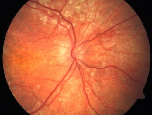 Basal Laminar Drusen - Cuticular Drusen - Equatorial Drusen - 70 Year Old Woman - Optic Nerve Photo Right Eye
70 year old woman has had macular drusen since her thirties and she said her sister has a similar problem.  Recently the vision in the left eye has substantially declined. OD 20/16, OS 10/200.
