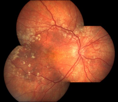 Basal Laminar Drusen - Cuticular Drusen - Equatorial Drusen - 70 Year Old Woman - Photo Montage Right Eye
70 year old woman has had macular drusen since her thirties and she said her sister has a similar problem.  Recently the vision in the left eye has substantially declined. OD 20/16, OS 10/200.
