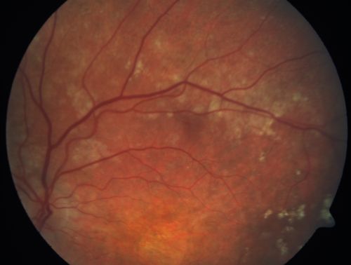 Basal Laminar Drusen - Cuticular Drusen - Equatorial Drusen - 70 Year Old Woman 
70 year old woman has had macular drusen since her thirties and she said her sister has a similar problem.  Recently the vision in the left eye has substantially declined. OD 20/16, OS 10/200.

