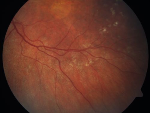 Basal Laminar Drusen - Cuticular Drusen - Equatorial Drusen - 70 Year Old Woman 
70 year old woman has had macular drusen since her thirties and she said her sister has a similar problem.  Recently the vision in the left eye has substantially declined. OD 20/16, OS 10/200.
