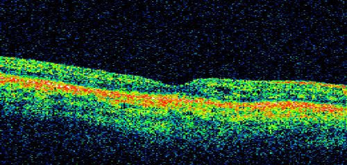 Basal Laminar Drusen - Cuticular Drusen - Equatorial Drusen - 70 Year Old Woman - OCT Line Scan Right Eye
70 year old woman has had macular drusen since her thirties and she said her sister has a similar problem.  Recently the vision in the left eye has substantially declined. OD 20/16, OS 10/200.
