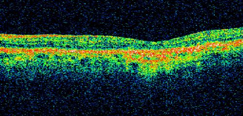 Basal Laminar Drusen - Cuticular Drusen - Equatorial Drusen - 70 Year Old Woman Line Scan Left Eye
70 year old woman has had macular drusen since her thirties and she said her sister has a similar problem.  Recently the vision in the left eye has substantially declined. OD 20/16, OS 10/200.
